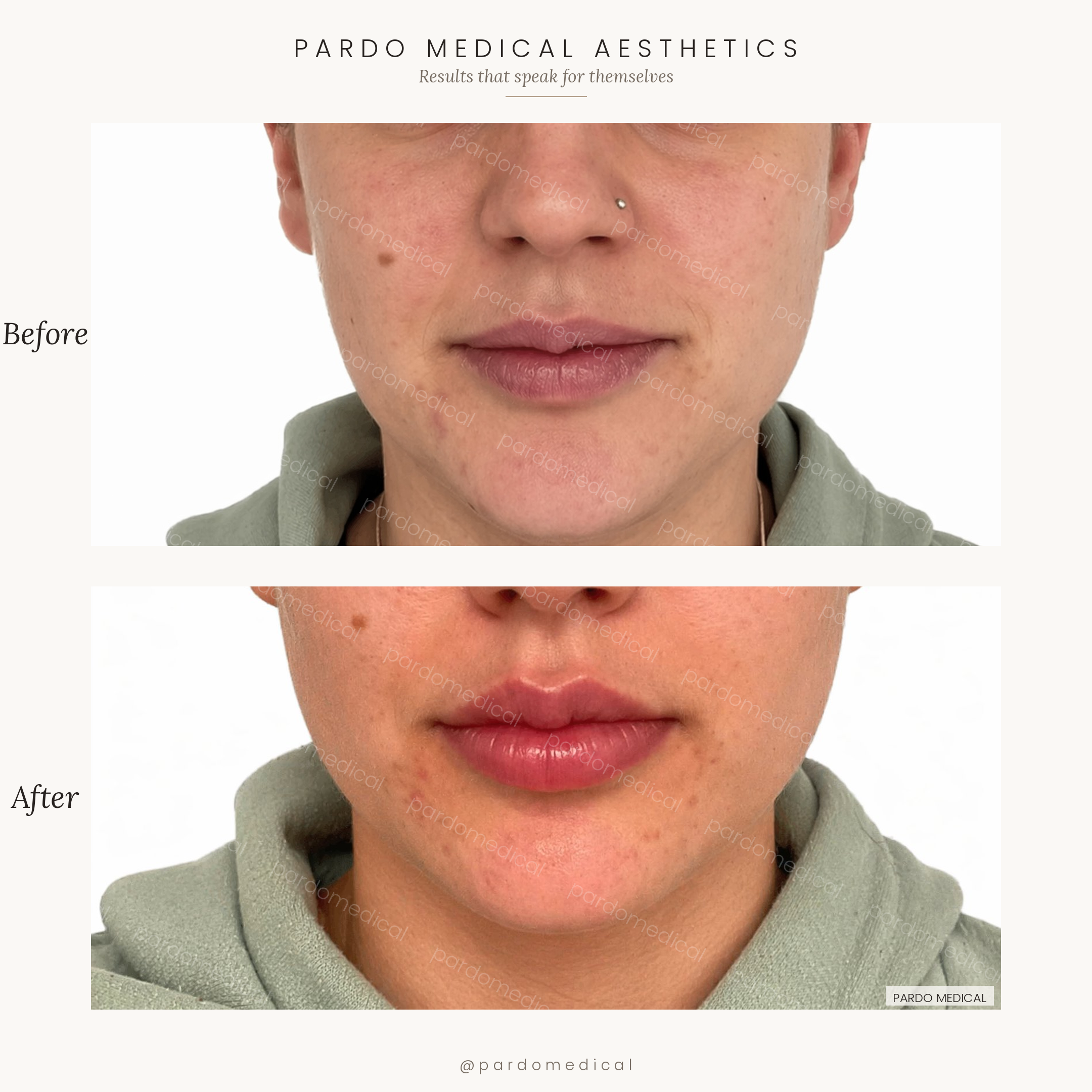 Lip filler before and after - contour redefinition and subtle volumisation