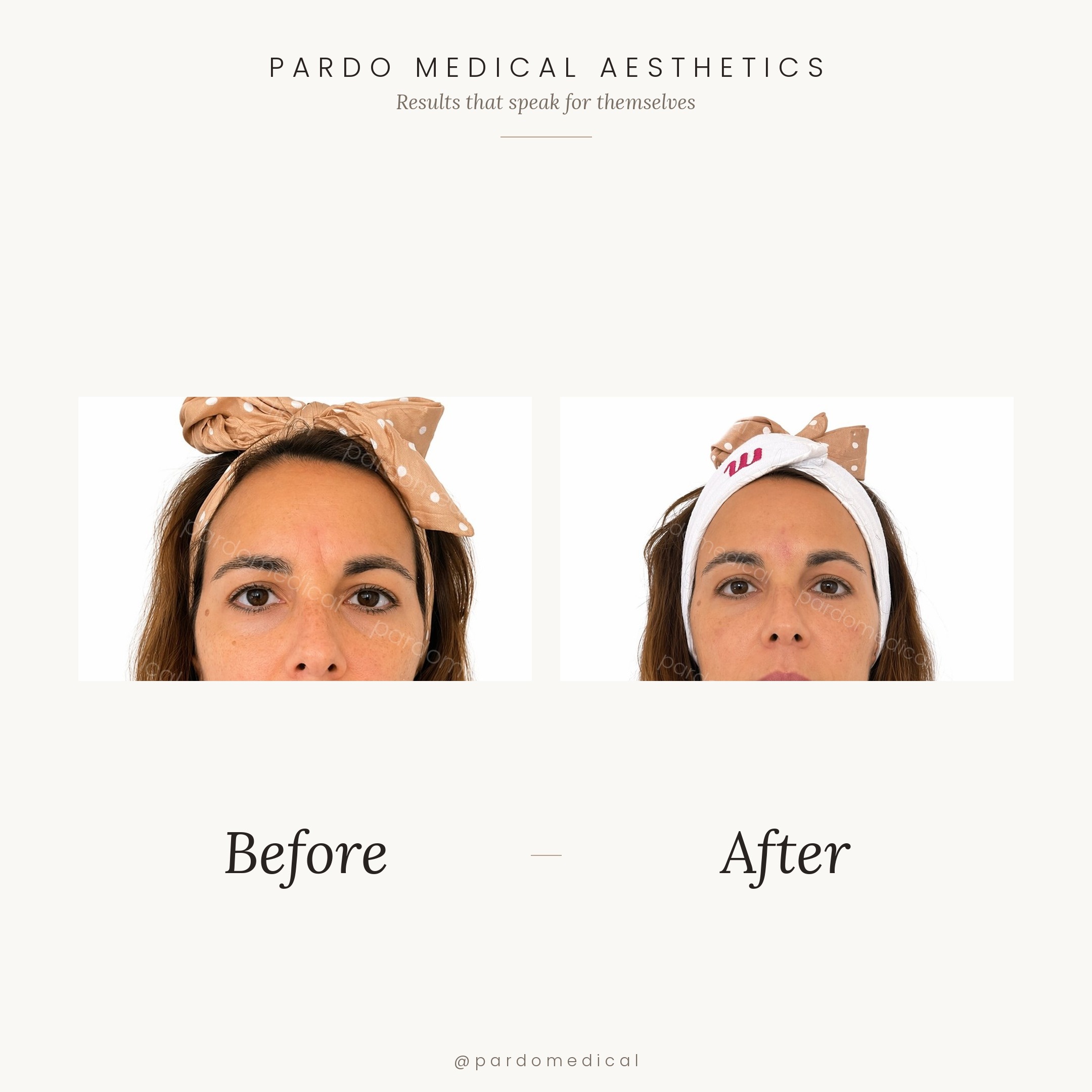 Tear trough filler and procerus wrinkle correction before and after