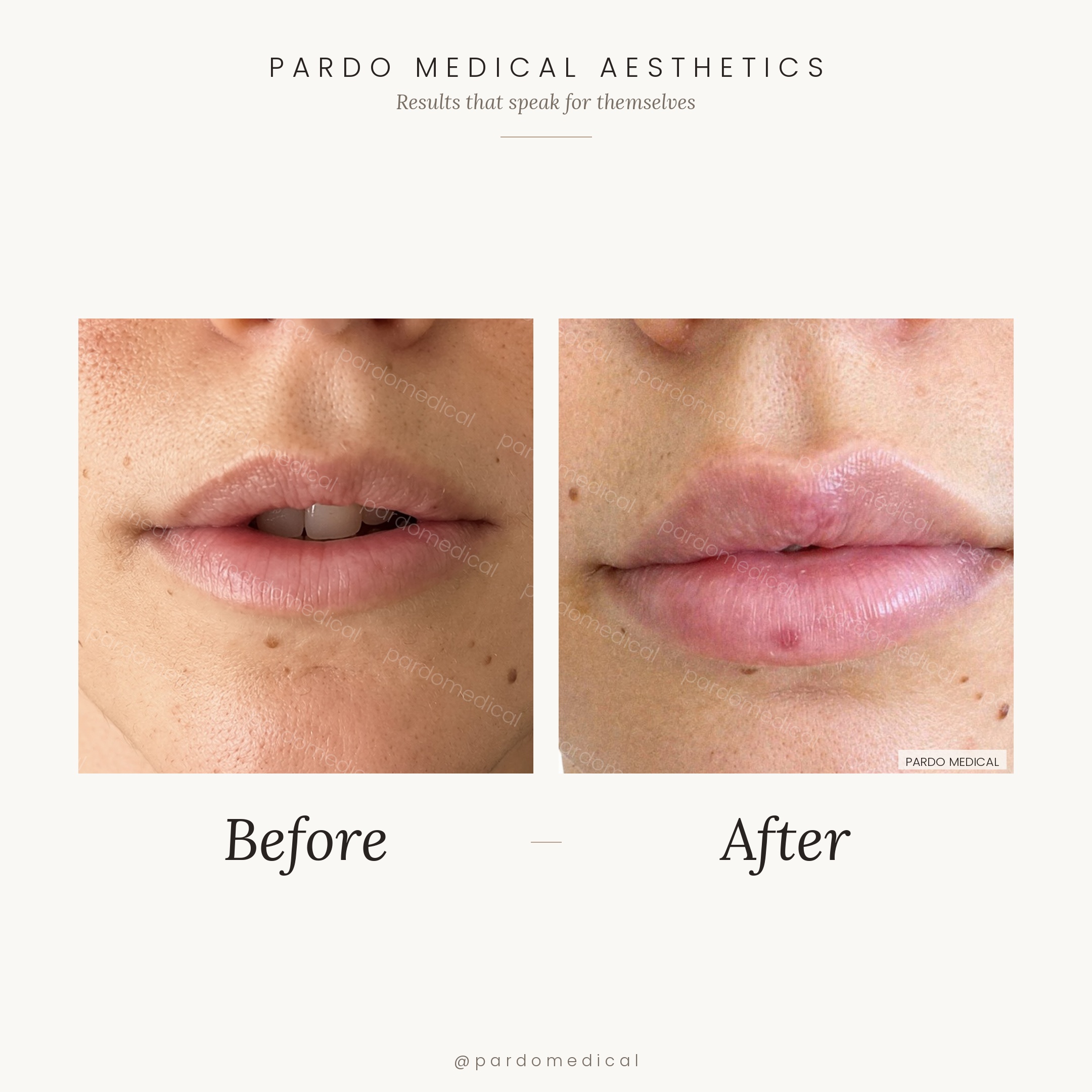 Lip filler before and after - contour definition and volume enhancement