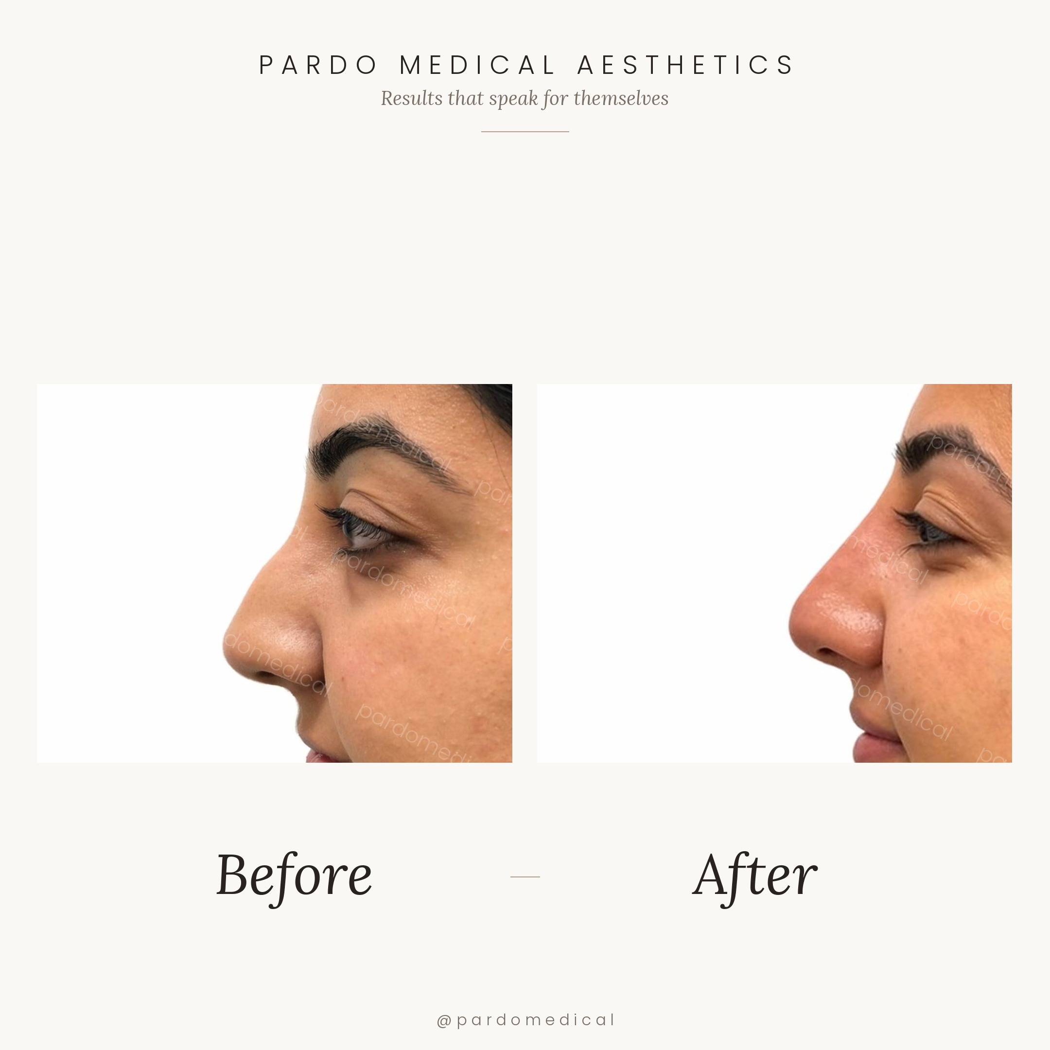 Non-surgical rhinoplasty before and after - nasal bridge refined