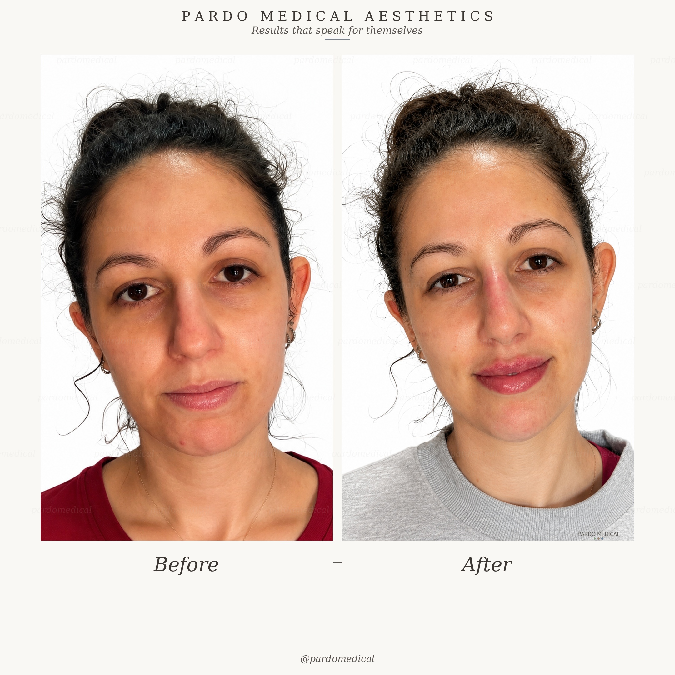Full facial contouring before and after - tear troughs, cheeks, rhinoplasty, chin and jawline remodellation