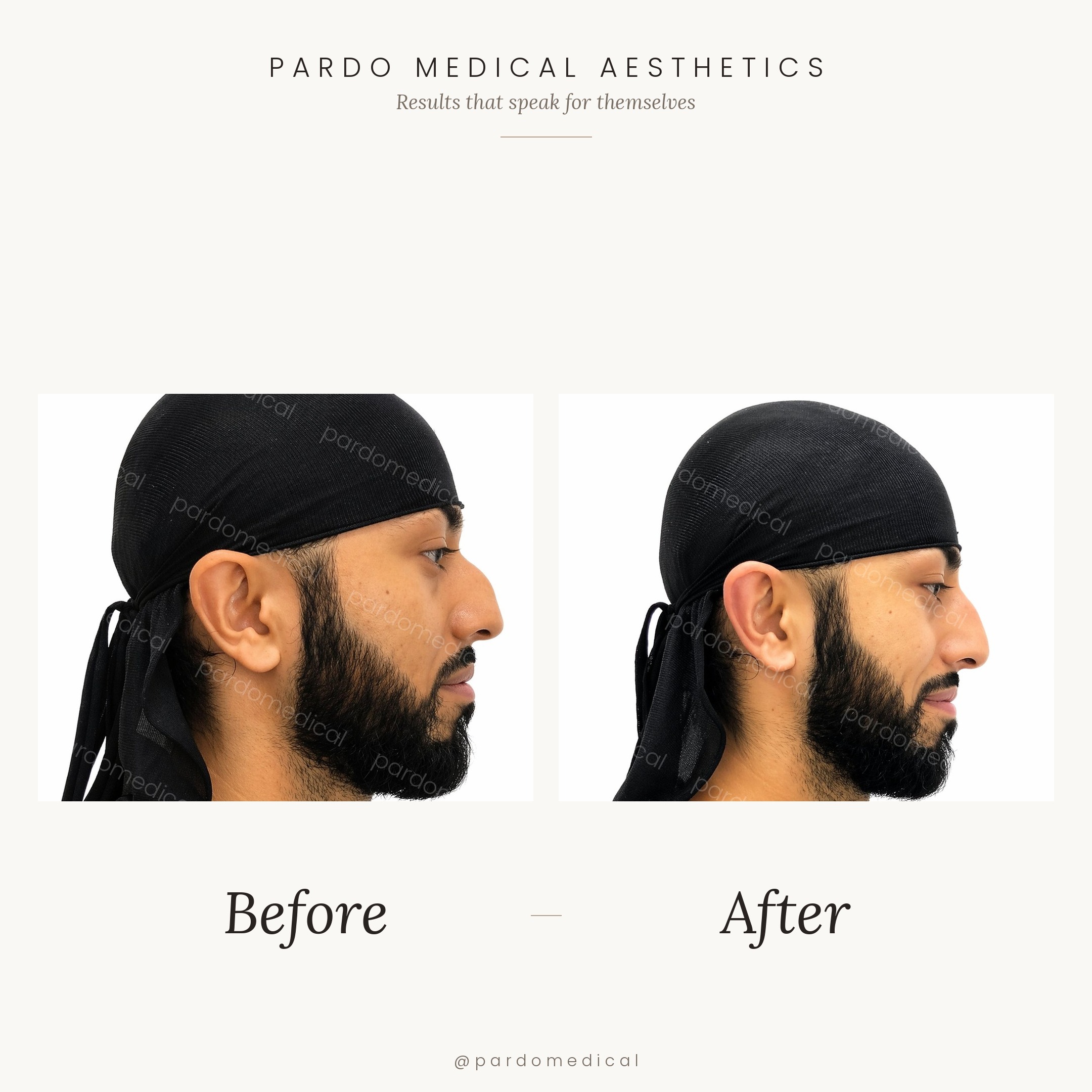 Male non-surgical rhinoplasty before and after - nasal dorsum correction