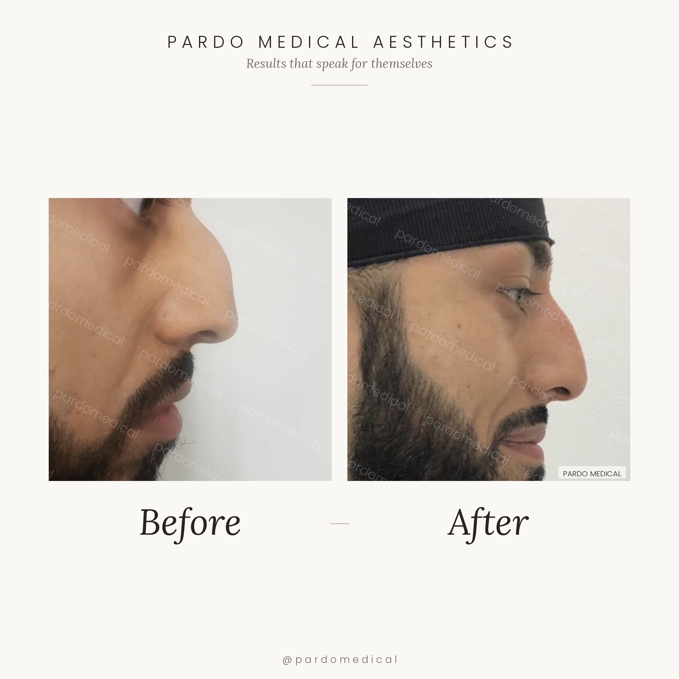 Male non-surgical rhinoplasty before and after close-up showing refined nasal bridge