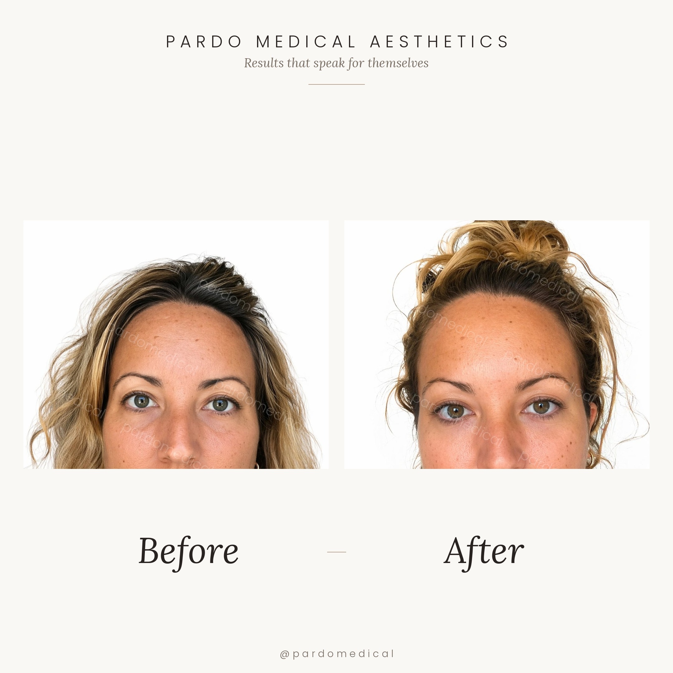 Tear trough filler before and after - under-eye hollowing corrected