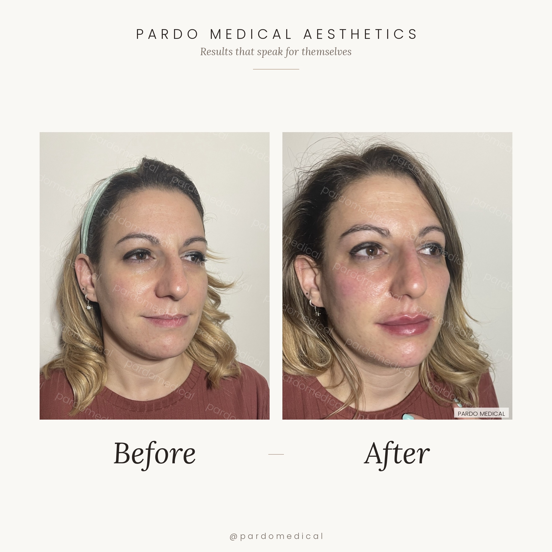 Facial contouring before and after - cheek augmentation, nose, lips, and chin
